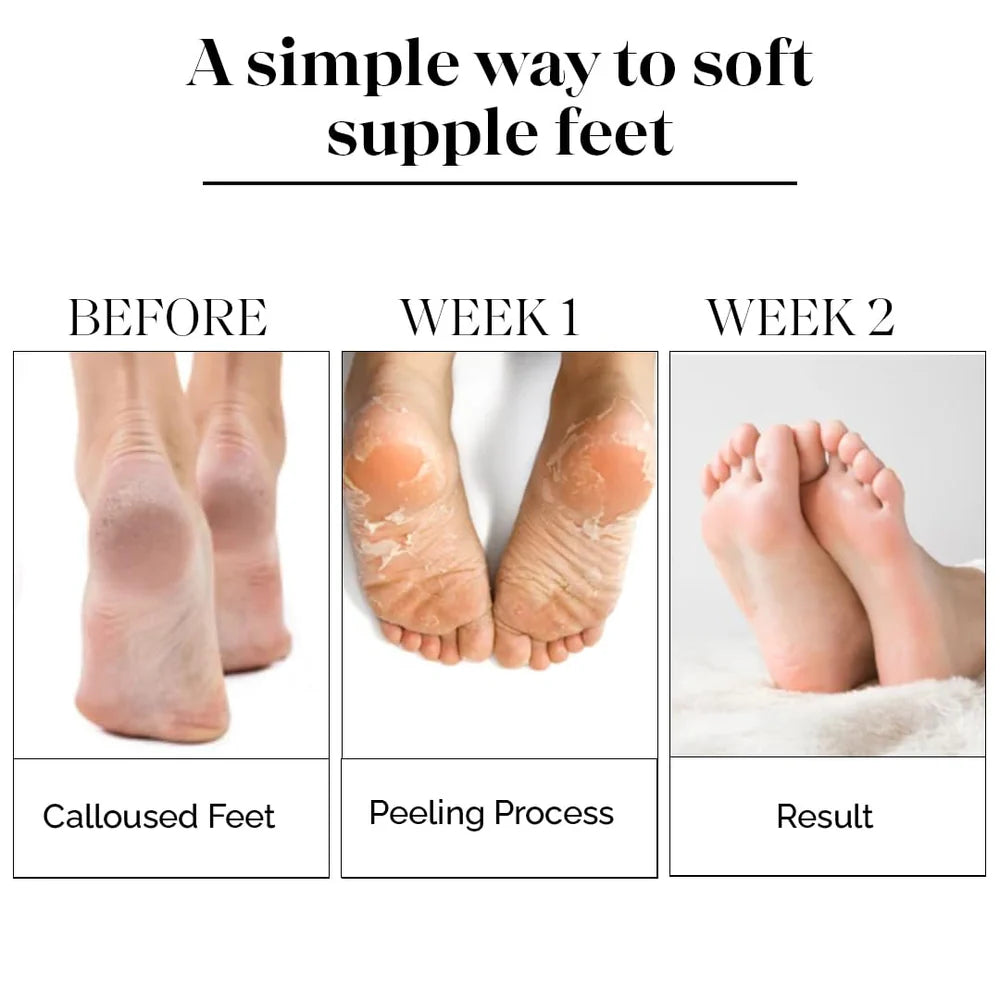 SilkSole™ | Soft Feet Peeling and Exfoliating Mask | With Korean skincare technology